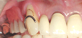 金属の鉤で固定する部分義歯